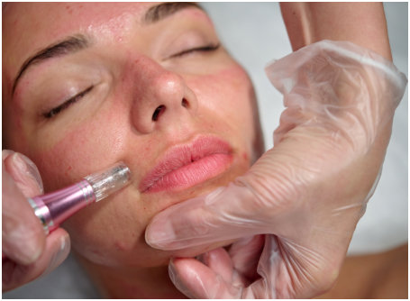 microneedling