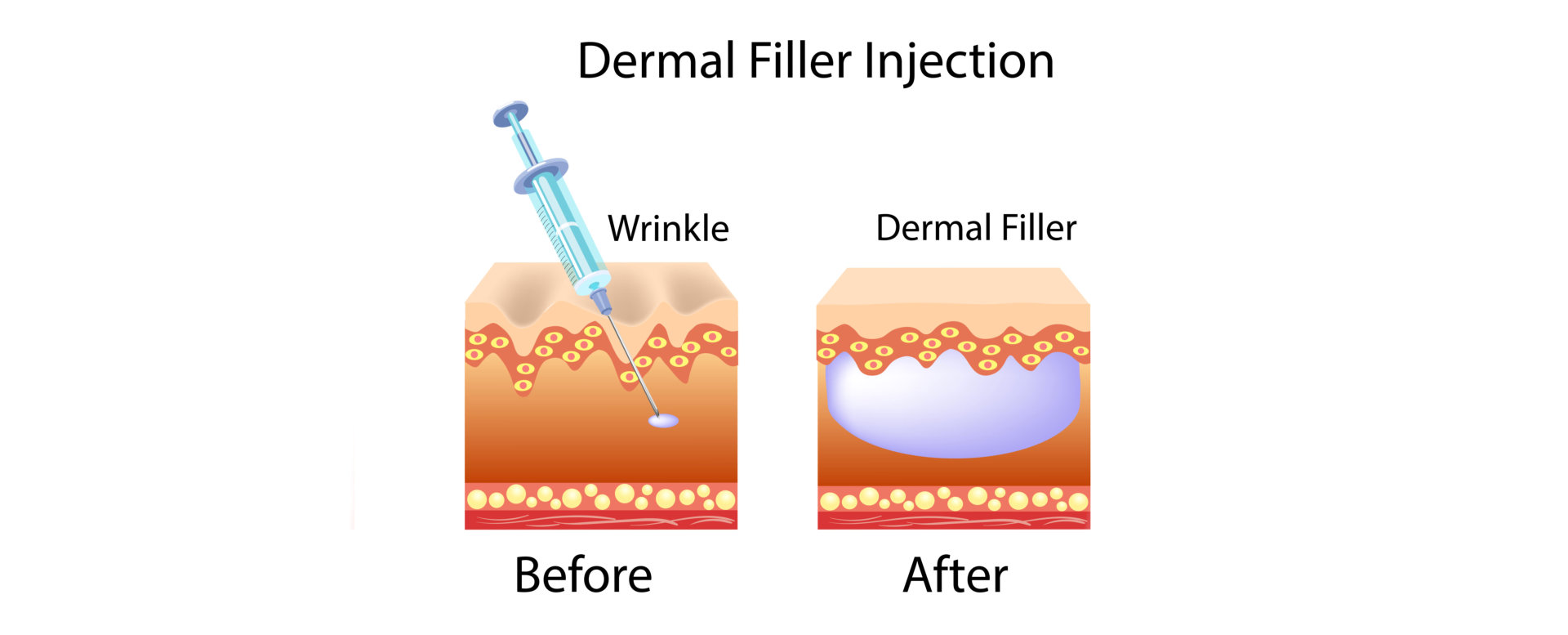 dermal filler injection