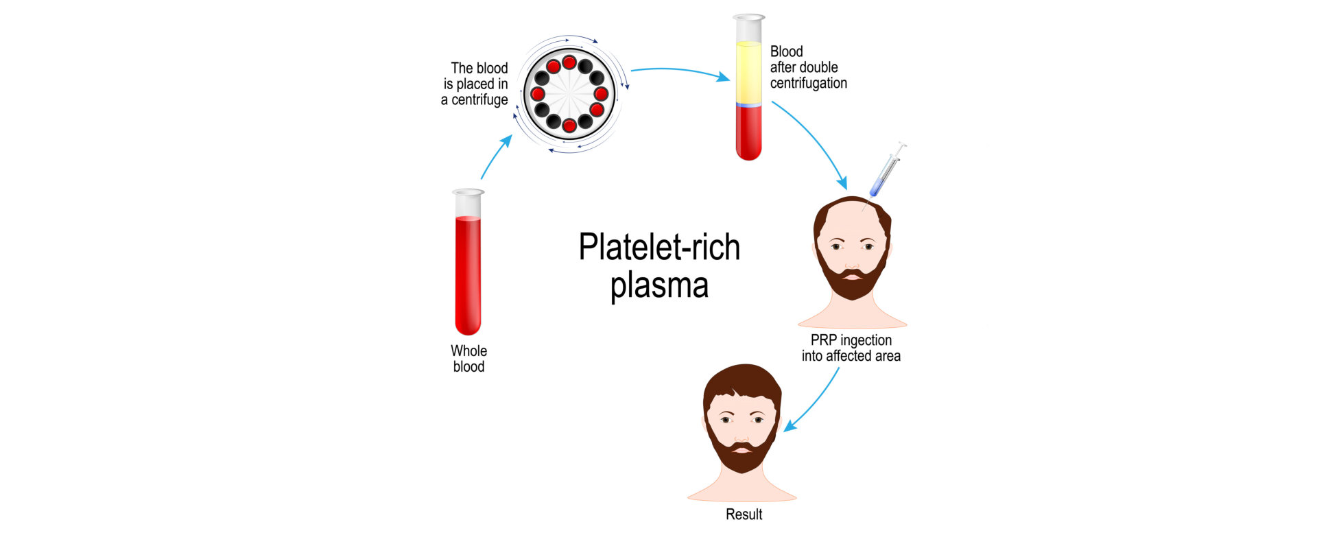 platelet-rich plasma