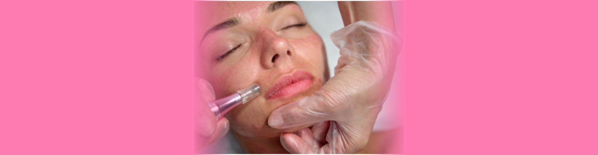 microneedling