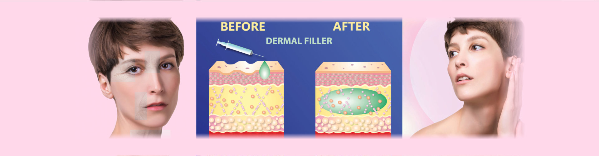 dental filler